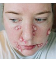 JessFX Prosthetic - Small Boils