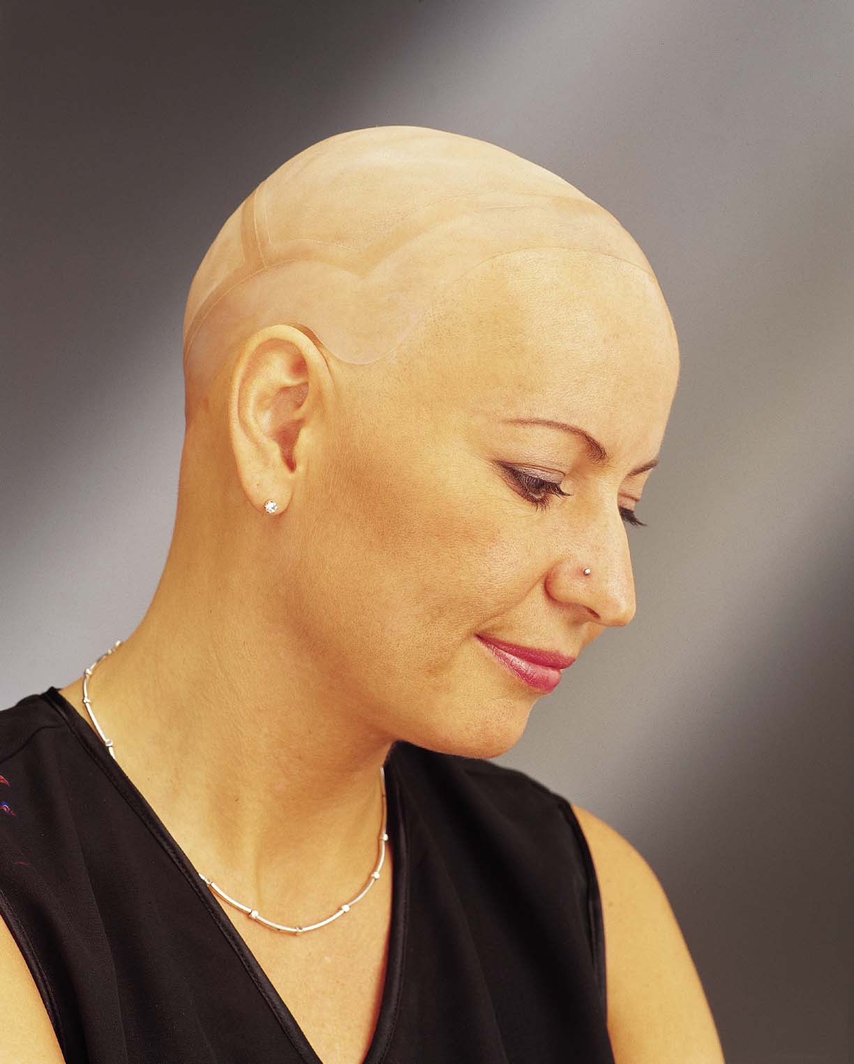 alopecia 